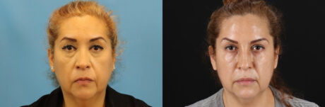 Botox® & Other Neuromodulators case #5051