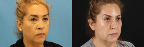 Botox® & Other Neuromodulators case #5051