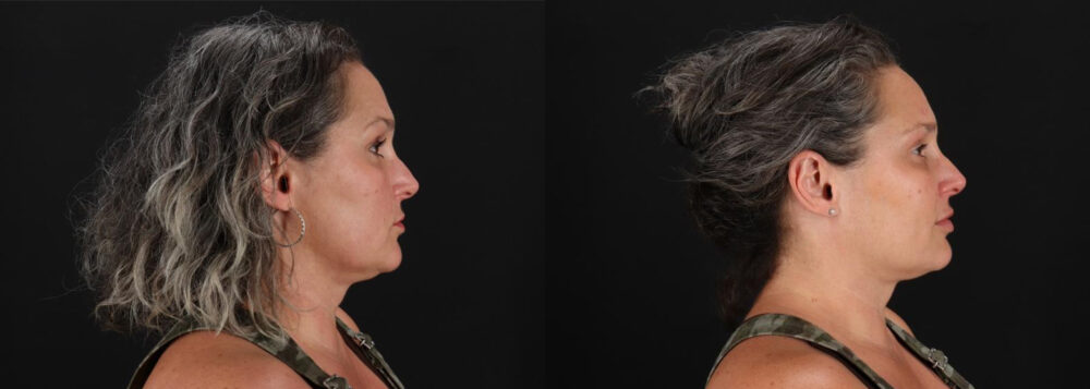 Botox® & Other Neuromodulators case #5056