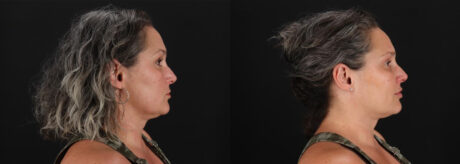 Botox® & Other Neuromodulators case #5056