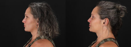 Botox® & Other Neuromodulators case #5056