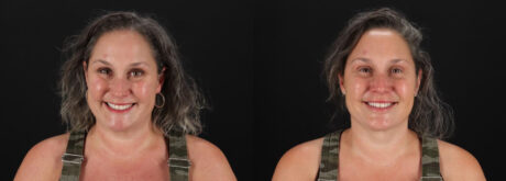 Botox® & Other Neuromodulators case #5056