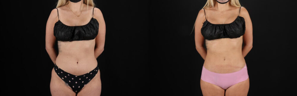 Liposuction case #6018