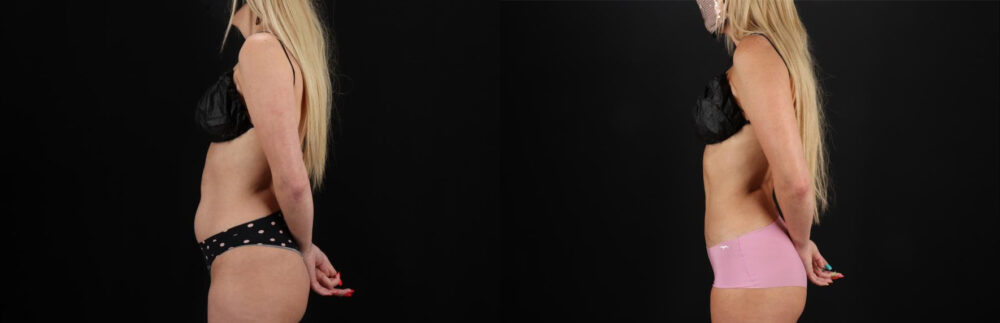 Liposuction case #6018