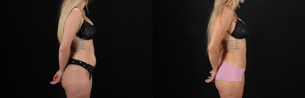 Liposuction case #6018