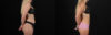 Liposuction case #6018 slider thumbnail