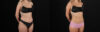 Liposuction case #6018 slider thumbnail