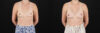Breast Augmentation case #6371 slider thumbnail