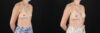 Breast Augmentation case #6371 slider thumbnail