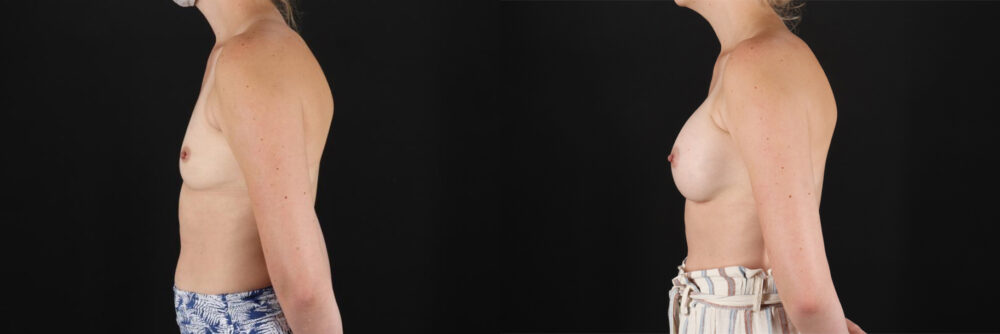 Breast Augmentation case #6371