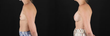 Breast Augmentation case #6371