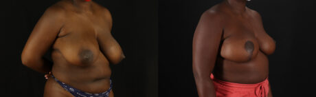 Breast Reduction case #7988