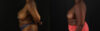 Breast Reduction case #7988 slider thumbnail