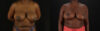 Breast Reduction case #7988 slider thumbnail