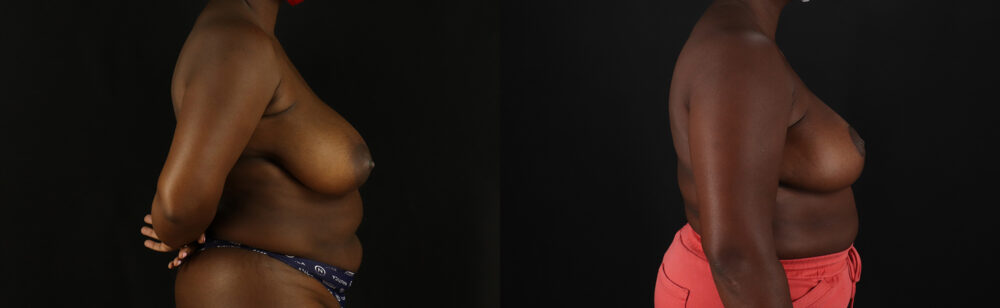 Breast Reduction case #7988