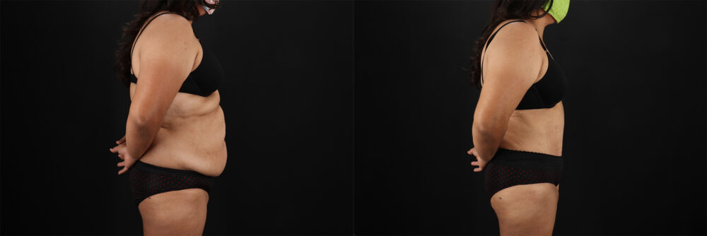 Tummy Tuck case #7354