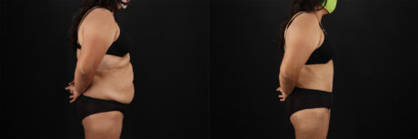 Tummy Tuck case #7354