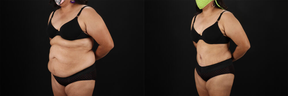 Tummy Tuck case #7354