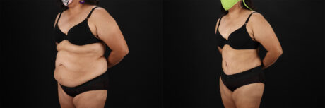 Tummy Tuck case #7354