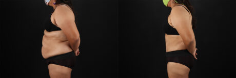 Tummy Tuck case #7354