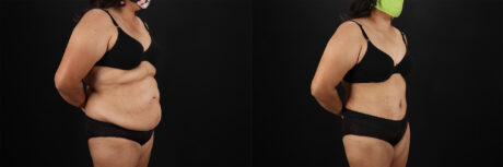 Tummy Tuck case #7354