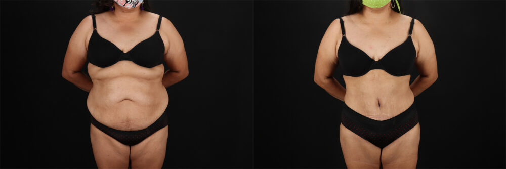 Tummy Tuck case #7354