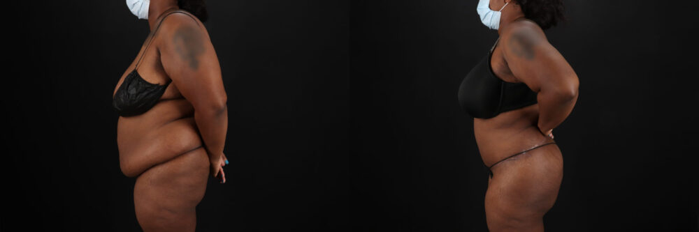 Tummy Tuck case #7353