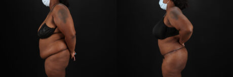 Tummy Tuck case #7353