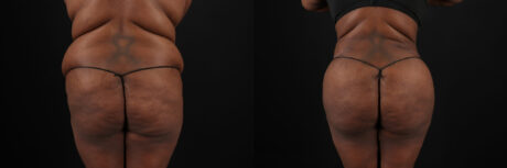 Tummy Tuck case #7353