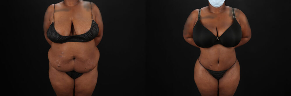 Tummy Tuck case #7353