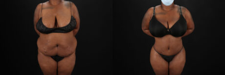 Tummy Tuck case #7353