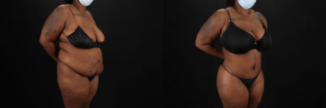 Tummy Tuck case #7353