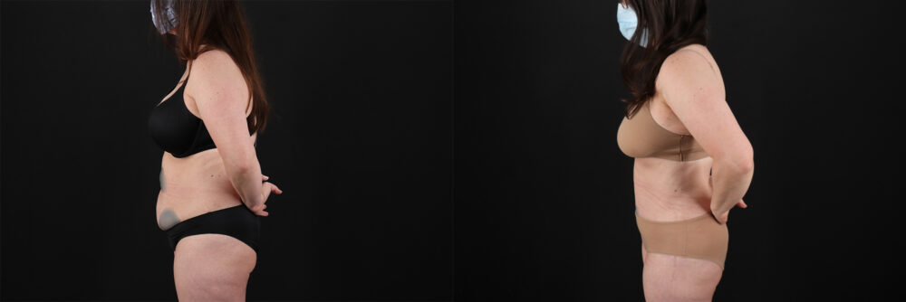 Tummy Tuck case #7460