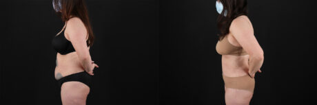 Tummy Tuck case #7460