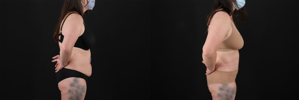 Tummy Tuck case #7460