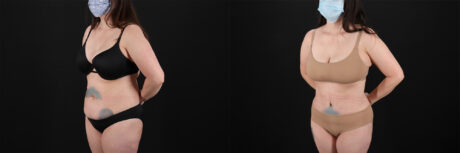 Tummy Tuck case #7460