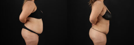 Brazilian Butt Lift case #5266