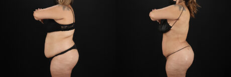 Brazilian Butt Lift case #5266