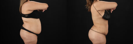 Brazilian Butt Lift case #5266