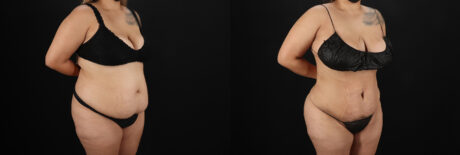 Brazilian Butt Lift case #5266