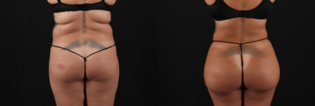 Brazilian Butt Lift case #5269