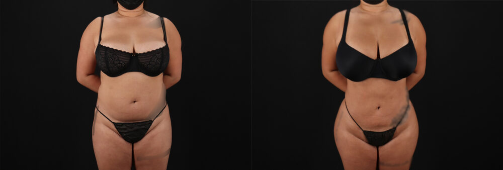 Brazilian Butt Lift case #5269