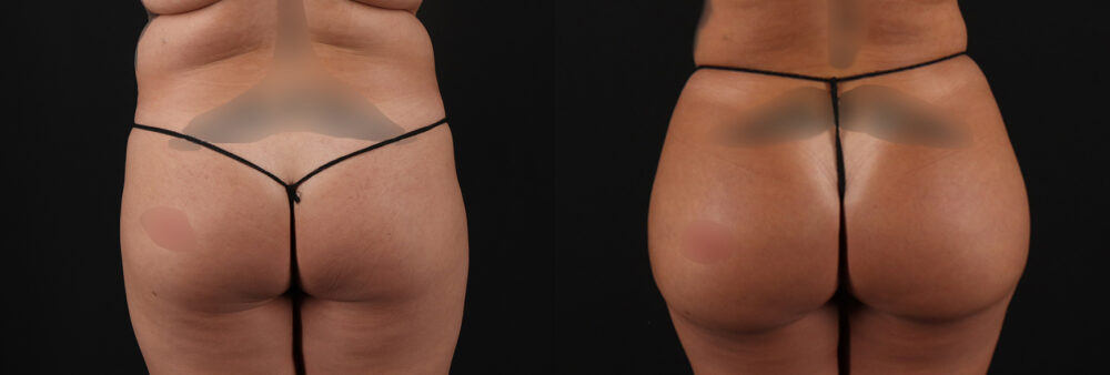 Brazilian Butt Lift case #5269