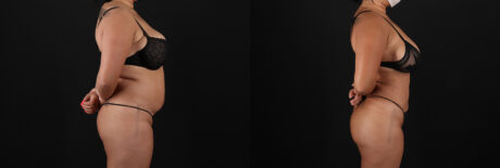 Brazilian Butt Lift case #5269