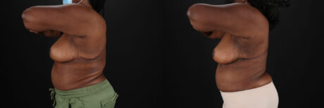 Post Bariatric Surgery (Massive Weight Loss) case #6781