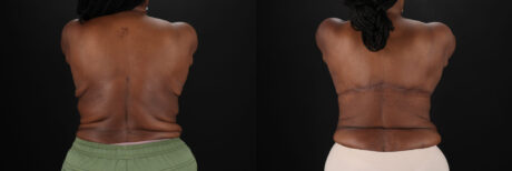 Post Bariatric Surgery (Massive Weight Loss) case #6781