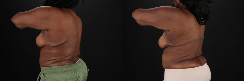 Post Bariatric Surgery (Massive Weight Loss) case #6781