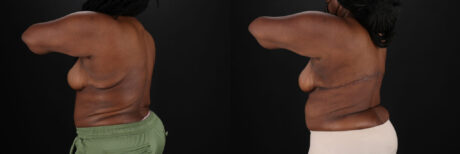 Post Bariatric Surgery (Massive Weight Loss) case #6781