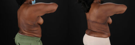 Post Bariatric Surgery (Massive Weight Loss) case #6781