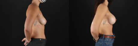 Breast Augmentation case #6378